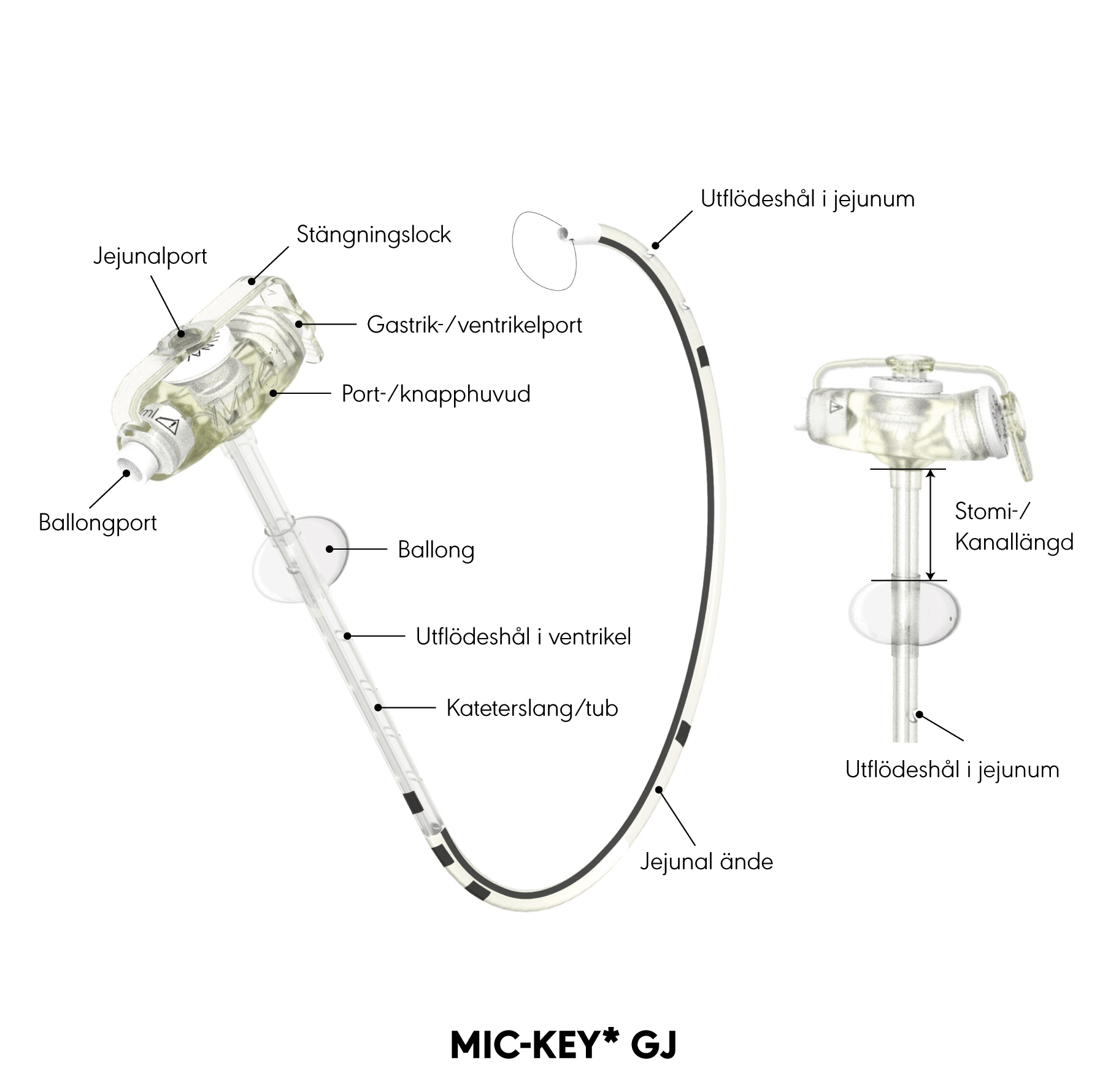 MIC-KEY* Gastric-Jejunal Feeding Tube